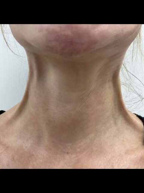 What is a Nefertiti Lift? ✨

The Nefertiti Lift is an anti-wrinkle  treatment that targets the platy