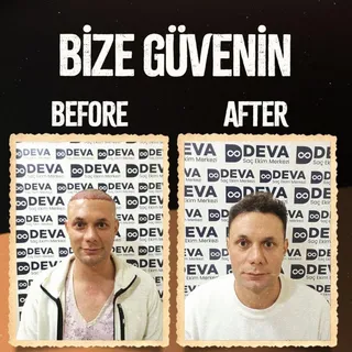 🌟 DHC Deva Hair Clinic ile Saç Ekimi 🌟
Güvenilir, profesyonel ve sonuç odaklı saç ekimi hizmetleri