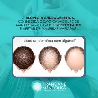 ALOPECIA ANDROGENÉTICA: MAIS COMUM DO QUE PARECE!

Você sabia que a calvície, conhecida cientificame