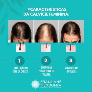 Alopecia Androgenética Feminina: Você sabe reconhecer os sinais?

A calvície feminina, diferente da 