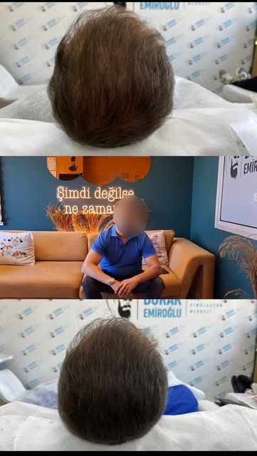 SAÇ SİMÜLASYON UYGULAMASI NEDİR ? 

👉 Saç Simülasyon uygulaması kişinin Saçının Seyrek olan bölgesi