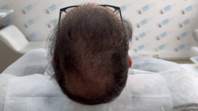 SAÇ SİMÜLASYON UYGULAMASI NEDİR ? 

👉 Saç Simülasyon uygulaması kişinin Saçının Seyrek olan bölgesi
