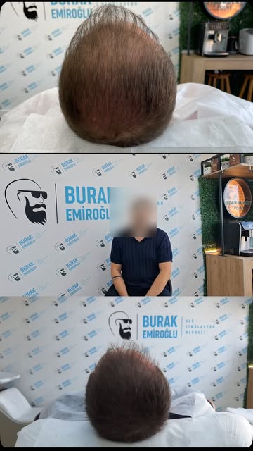 SAÇ SİMÜLASYON UYGULAMASI NEDİR ? 

👉 Saç Simülasyon uygulaması kişinin Saçının Seyrek olan bölgesi