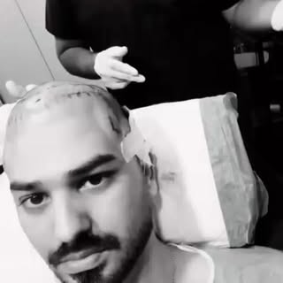 Best Hair Transplant Best Results 

WhatsApp Us: 0341 8126080
OR
Visit us:Maalee Jee Skin Center Nea