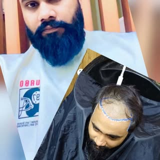 Hair Transplant Before & After

3253 Grafts | 10 Months Results

Hair transplant can deliver natural