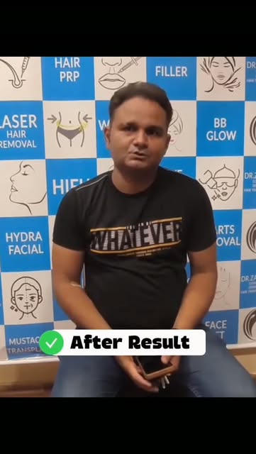 5053 Grafts | 09 Months Results

Hair transplant can deliver natural and dense results with the righ