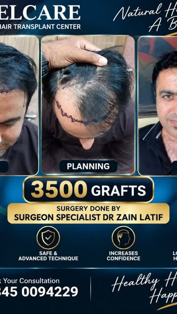 8 month hair transplant result