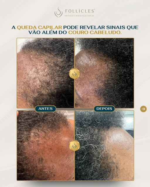 A Cleonice não chegou à Follicles com uma única queixa.
O cabelo caía, a região capilar já mostrava 