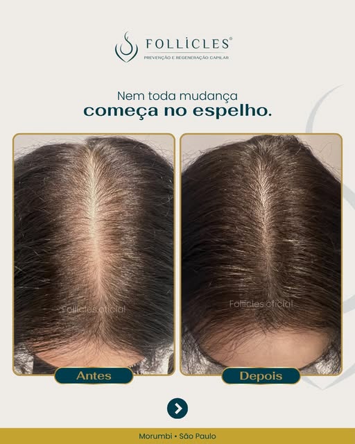 A Solange chegou à Follicles muito aflita com a queda de cabelo e com a perda de densidade que já co