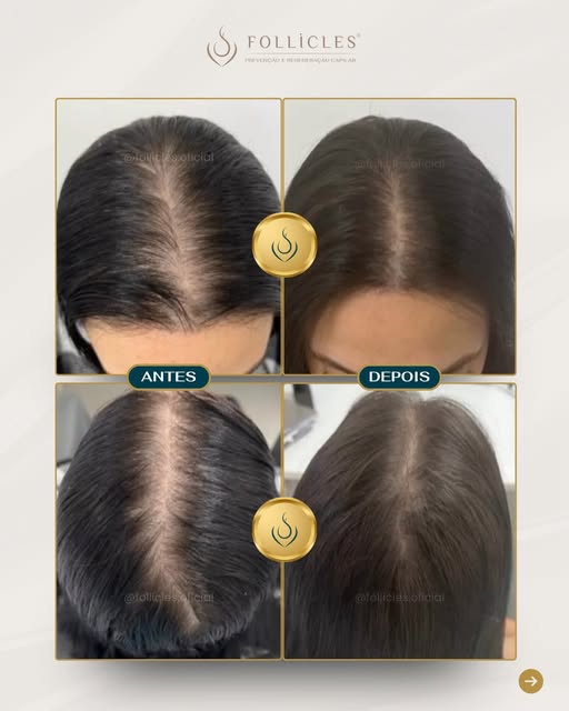 Ela não chegou à Follicles procurando um milagre. Chegou em um momento delicado, convivendo com qued