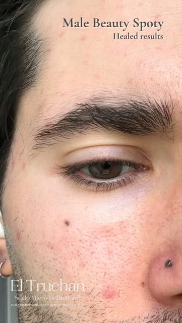 The Subtle Charm of the Beauty Spot 😍
Sometimes, it is the smallest details that make the most impa