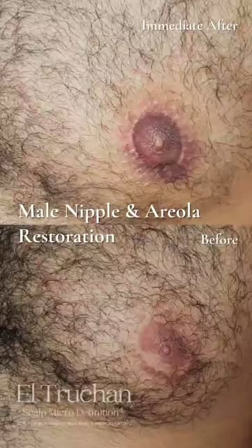 Male Nipple & Areola Restoration 💫

The appearance of the male nipple and areola can change for man
