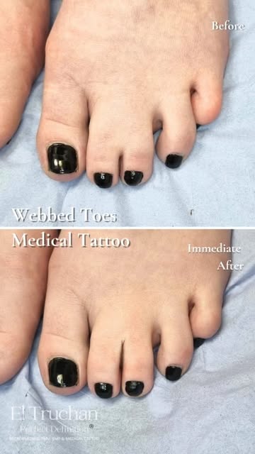 For many people with webbed toes, choosing open shoes or walking barefoot can bring years of self-co