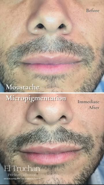 Moustache Micropigmentation Colour Boost 👨🏻

When facial hair grows unevenly, or no longer grows i
