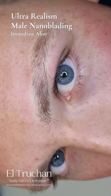 Losing eyebrow hair can change how you recognise yourself in the mirror. 
For men experiencing parti