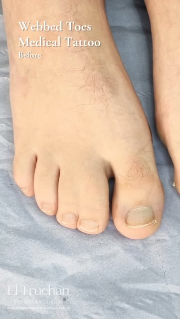 For some people, webbed toes are simply part of how their feet have always looked. For others, they 
