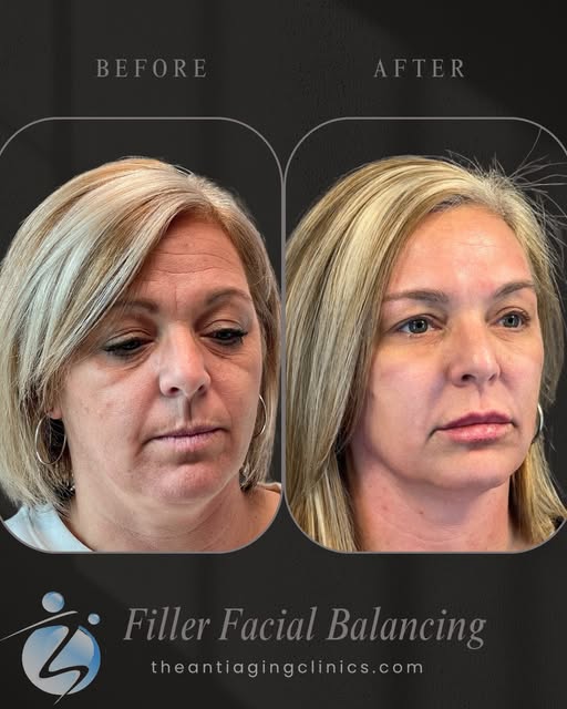 Natural facial balancing is all about harmony ✨
Soft contouring, subtle structure, and refreshed vol