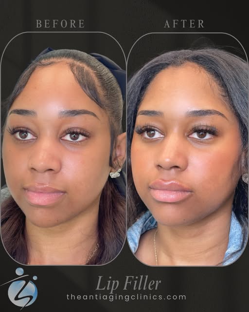 She already had gorgeous natural volume, so this wasn’t about making her lips bigger — it was about 