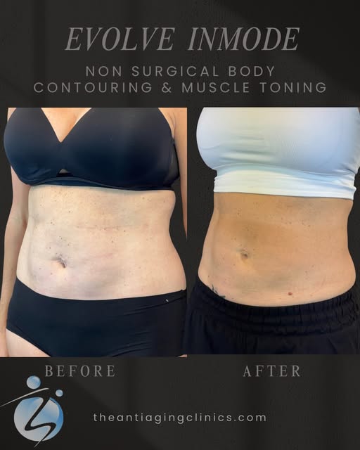 BODY CONTOURING, REIMAGINED ✨

Meet EvolveX by InMode — a completely non-invasive, hands-free treatm