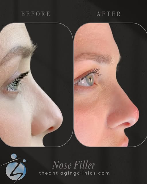 Tinkerbell Tip Lift- lifting the tip of the nose✨
Non-surgical rhinoplasty uses precisely placed der
