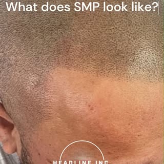 Before and Afters of SMP work at Headline Inc. Get a free consults & quote now (book via the website