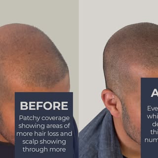 This handsome guy walked out of his final SMP session looking incredible. Early hair loss can be a b