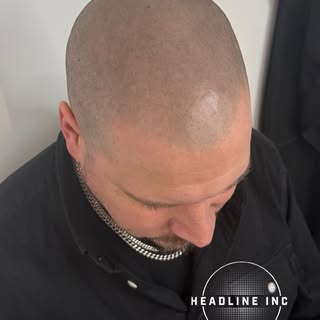 HEALED SMP! One year ago we completed 3 sessions of SMP that have healed completely down beautifully