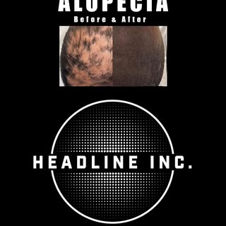 Alopecia can be a challenging condition, and we've been privileged to work with both men and women w