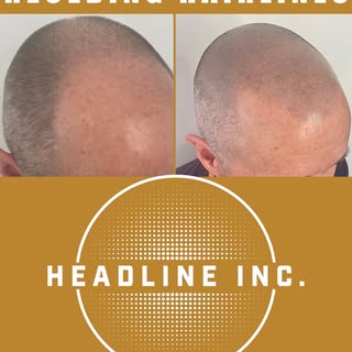 When your hairline has gone AWOL, we can help return it to where it used to be, with SMP! You'll be 