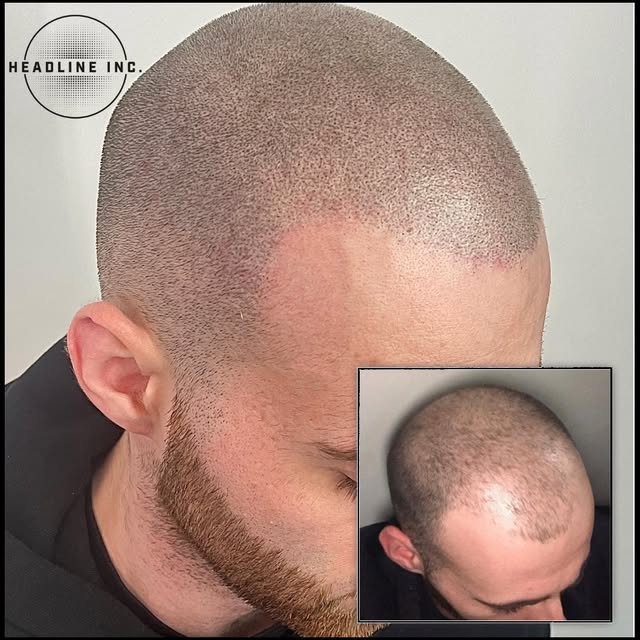Isn't this a great example of how SMP can freshen your look?
Get a free consult and personal quote v