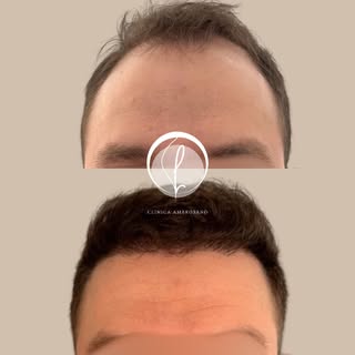 Resultado de apenas 8 meses!!! Cada transplante capilar é único.
Esse resultado que você está vendo 