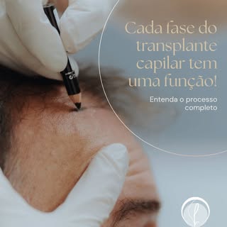Um transplante capilar vai MUITO ALÉM do dia da cirurgia. 

Deslize para o lado e conheça como funci