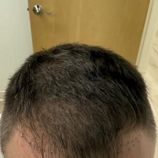 Mondays..hair days..
#hair #hairtransplant #ageless #maine