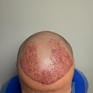 Updated patient from yesterday. Looks like a nice, new hairline. Zero pain. #hair #hairtransplant #f