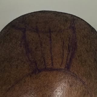 Neograft in action. Hand held. 
#hair #hairtransplant #falmouth