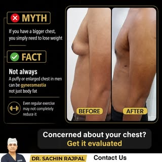 Chest Fat or Gynaecomastia? It’s Not Always About Being Unfit.

Think having a fuller or puffy chest