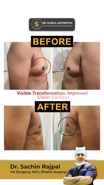 Gynecomastia can change the way the chest looks—but it can be treated. 

Gynecomastia is enlargement