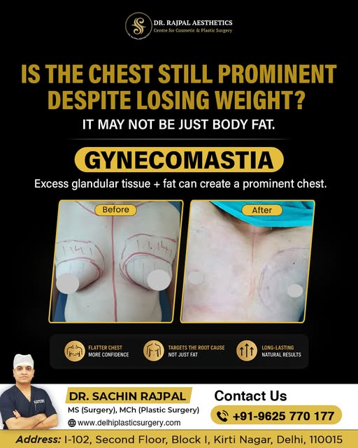 When a Bigger Chest Becomes a Confidence Problem

A prominent or enlarged chest in men can make T-sh