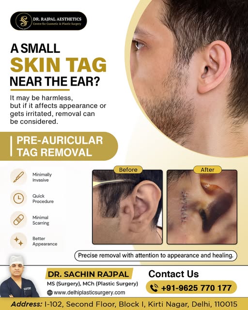 A Small Tag Near the Ear Can Be Removed Safely

A pre-auricular tag is a small extra piece of skin o