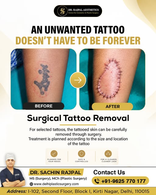 An Unwanted Tattoo Doesn’t Have to Be Forever

For selected tattoos, surgical tattoo removal can hel