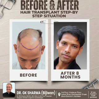 8 months later and the results speak for themselves! 🔥 Expert hair transplant surgery by Haridwar’s