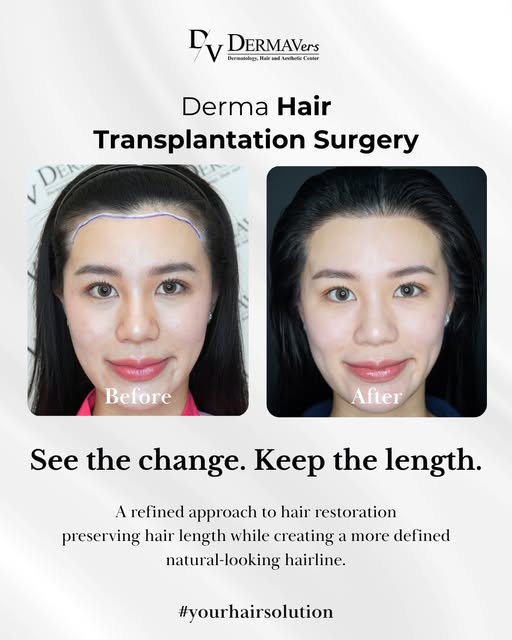 FRAME YOUR FACE. RESTORE YOUR HAIR. ✨

For women, a hairline is more than just hair, it helps define
