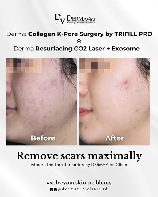 Acne scar masih terlihat dan bikin kurang pede? 👀

Lihat perubahan setelah 𝐃𝐞𝐫𝐦𝐚 𝐂𝐨𝐥𝐥𝐚𝐠�