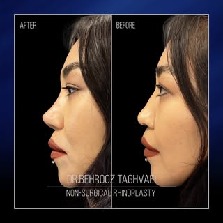 ‏⚡️Non-surgical Rhinoplasty in 5 minutes.

‏‎اصلاح فرم بینی بدون جراحی در پنج دقیقه ✨

‏⚡️Ոչ վիրահատ