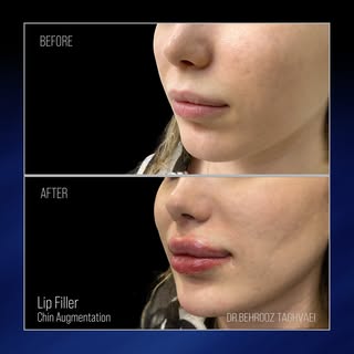 ✨Lip & Chin Filler : فیلر لب و چانه✨
Using 1ml hyaluronic acid per area to enhance the shape with a 