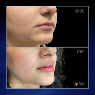 ✨‏‎‏Lip Filler✨
‎‏‎‏Using: 1ml of hyaluronic acid filler
‎‏Natural look &
‎‏‎‏Immediate  results Բնա