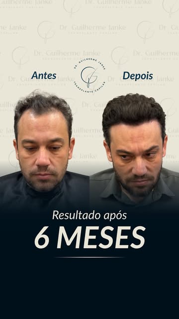 Os resultados de um transplante capilar bem executado são construídos etapa por etapa, com planejame