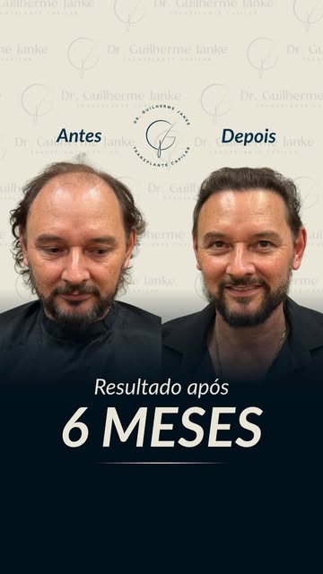 Resultado de 6 meses! ✨

Um transplante capilar de excelência vai muito além da cirurgia: envolve té