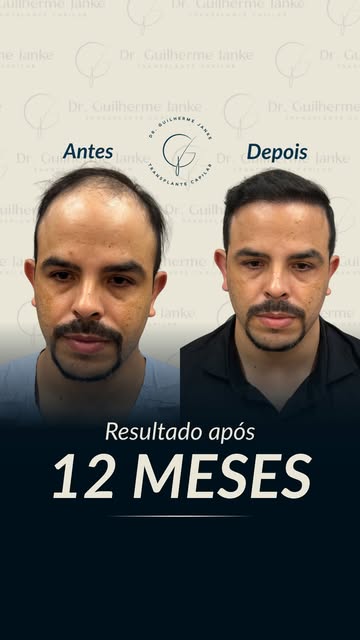 1 ano depois e o resultado fala por si!

Naturalidade, densidade e uma nova moldura para o rosto, tu