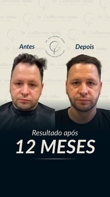 Resultado com 100% de evolução em 1 ano!

Mais um caso de sucesso com o transplante capilar realizad